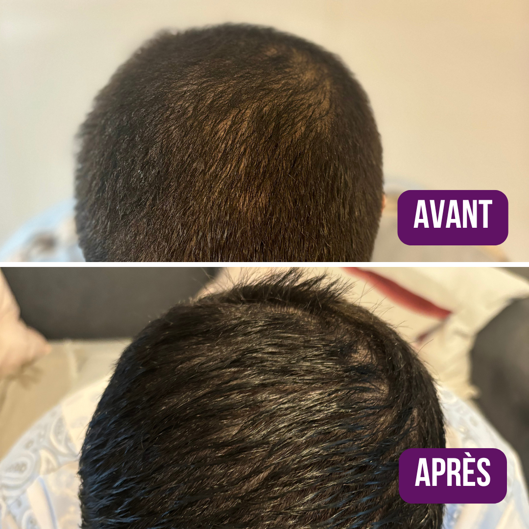 Lotion Pousse Extrême & Anti Chute de Cheveux - 100 ml - Sans Rinçage - PRE COMMANDE